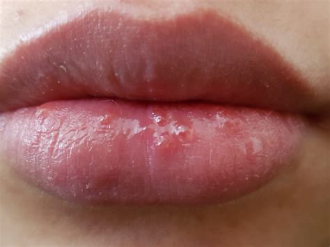 granitos en los labios-1